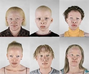 Hipopigmentasi - Albino