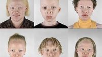 Hipopigmentasi - Albino