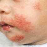 Dermatitis Atopi Pada Bayi