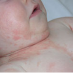 Dermatitis Seboroik Pada Bayi
