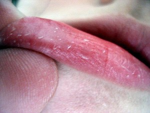 Tips dan Cara Mengatasi Bibir Pecah-Pecah
