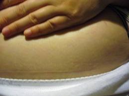 OPERASI CAESAR :: Tips dan Cara Merawat Bekas Operasi ...