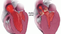 Penyakit Jantung Stenosis Mitral