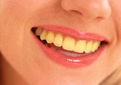 Penyebab Warna Gigi Bisa Berubah