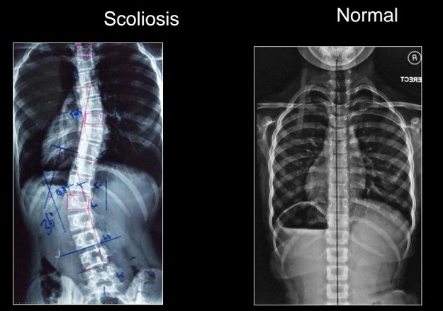 Scoilosis vs Normal Bone