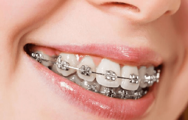 7 Tips Merawat Gigi dan Mulut Bagi Pengguna Behel
