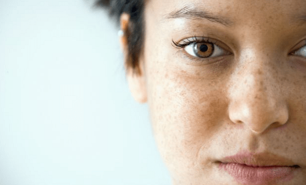 8 Cara Alami Menghilangkan Flek Hitam di Wajah