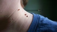 Penyebab Skin Tag Dan Cara Alami Mengatasinya